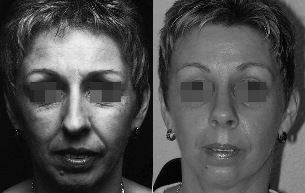 rhinoplastie fonctionnelle tunisie