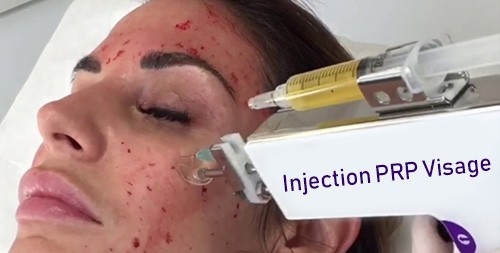 deroulement-injection-prp-visage