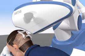 Les implants pour épaissir la chevelure avec le robot Artas