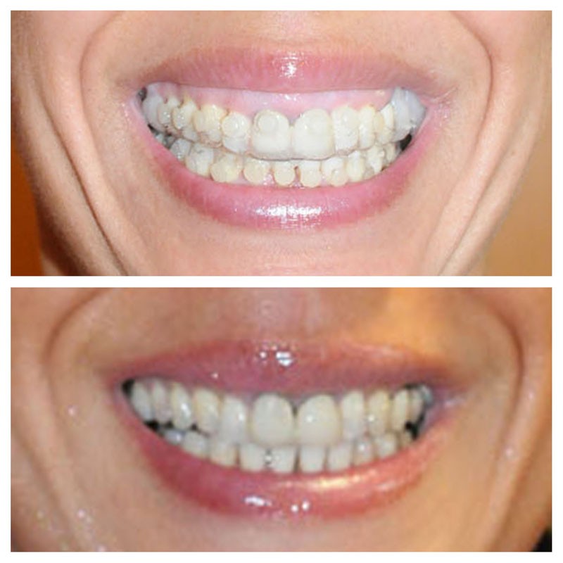 forfait sourire gingivale + implant dents tunisie