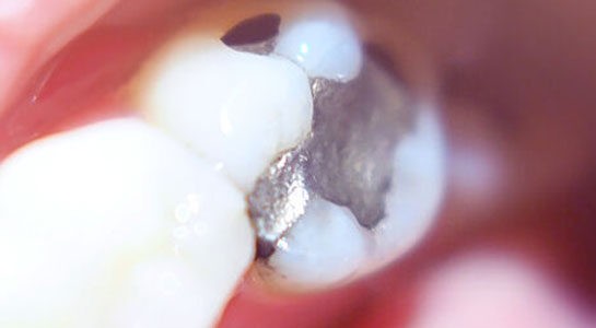 Remplacement plombages dentaire cassés ou décolorés en Tunisie