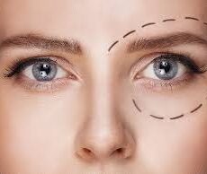 Chirurgie contour des yeux : Prix chirurgie patte d’oie