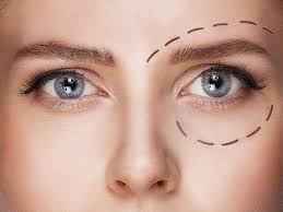 Chirurgie contour des yeux : Prix chirurgie patte d’oie