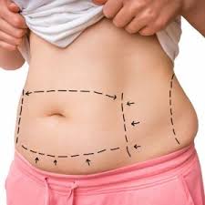 Abdominoplastie + BBL en Tunisie : Guide complet et prix