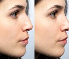 Prix de la rhinoplastie pour une bosse sur le nez