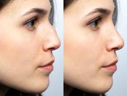 Prix de la rhinoplastie pour une bosse sur le nez