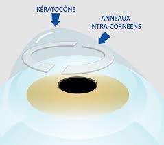 Les anneaux intracornéens : Une Solution Innovante pour le Kératocône