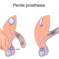 Prothèse Pénienne Gonflable : Guide complet