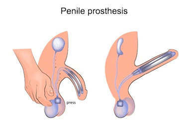 Prothèse Pénienne Gonflable : Guide complet