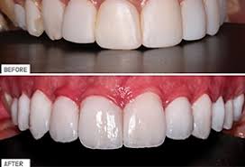 veneers before after dibai